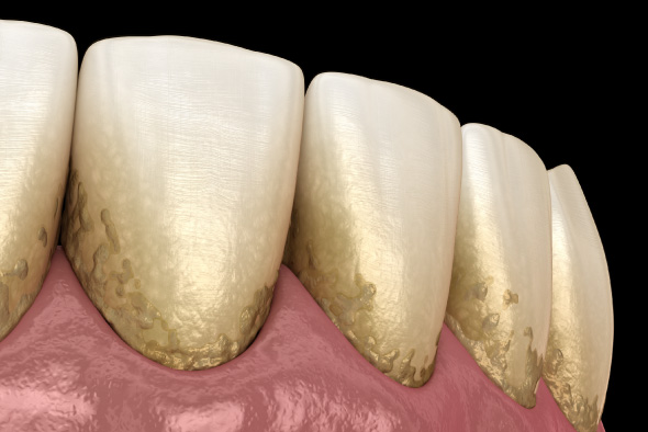 歯周病の主な原因について