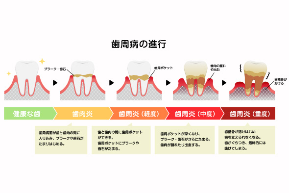 歯周病治療の流れ